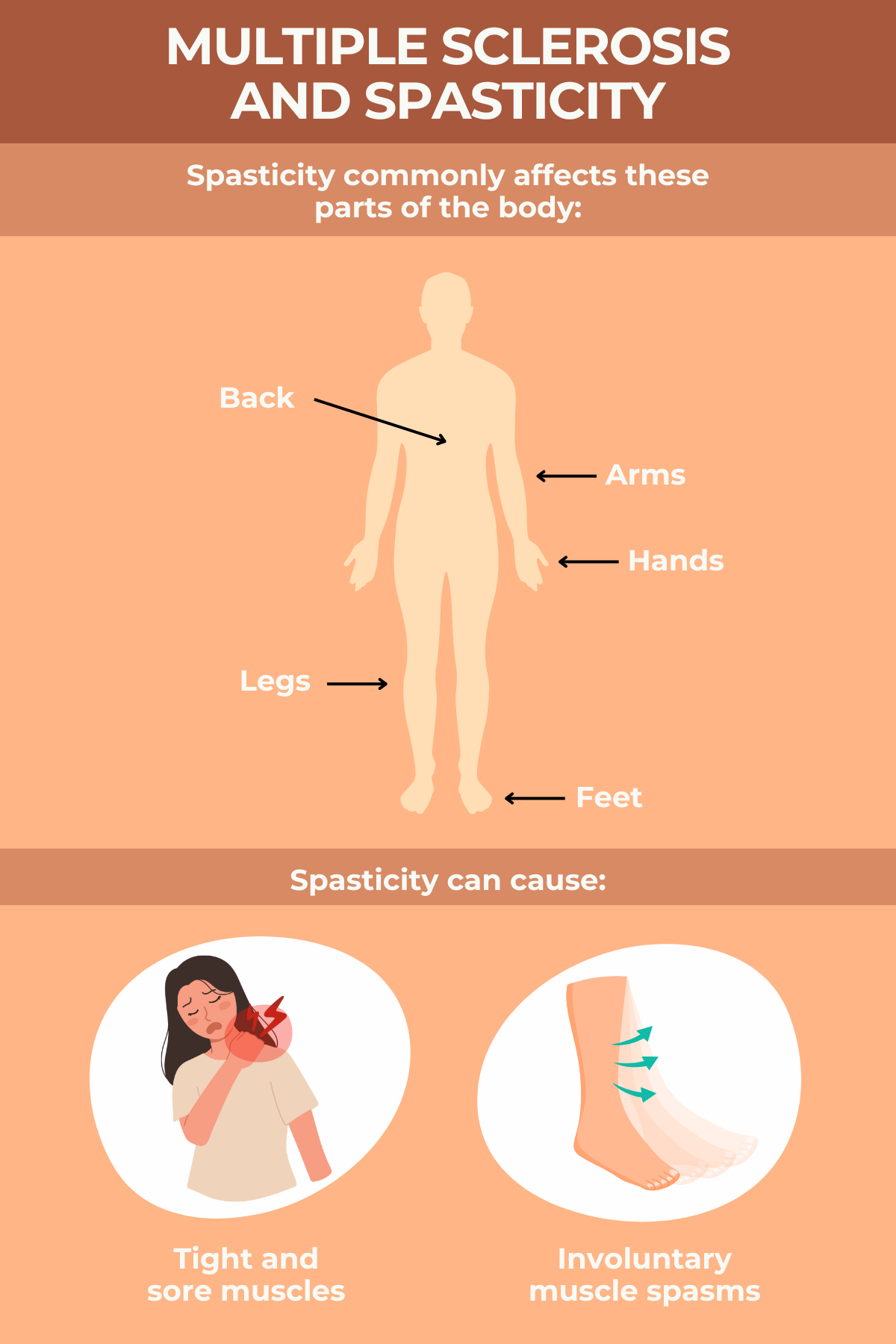 MS spasticity What does it feel like? Multiple Sclerosis News Today