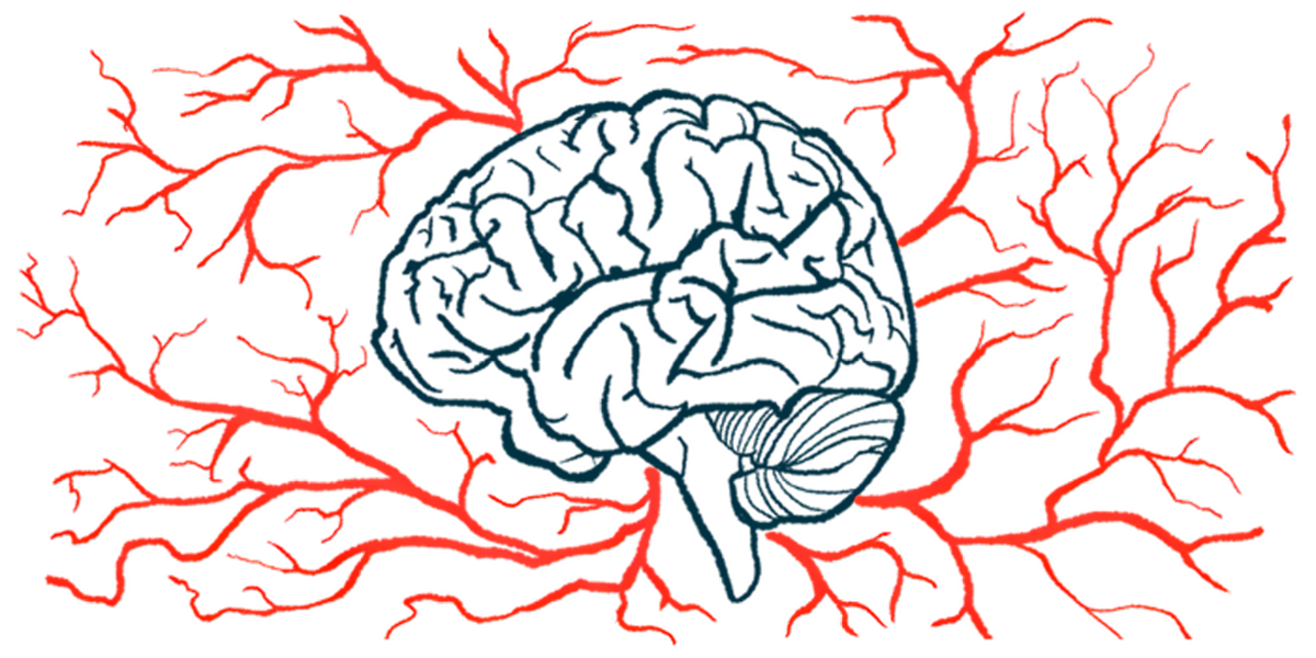 An illustration shows a profile of the human brain amid a host of blood vessels.