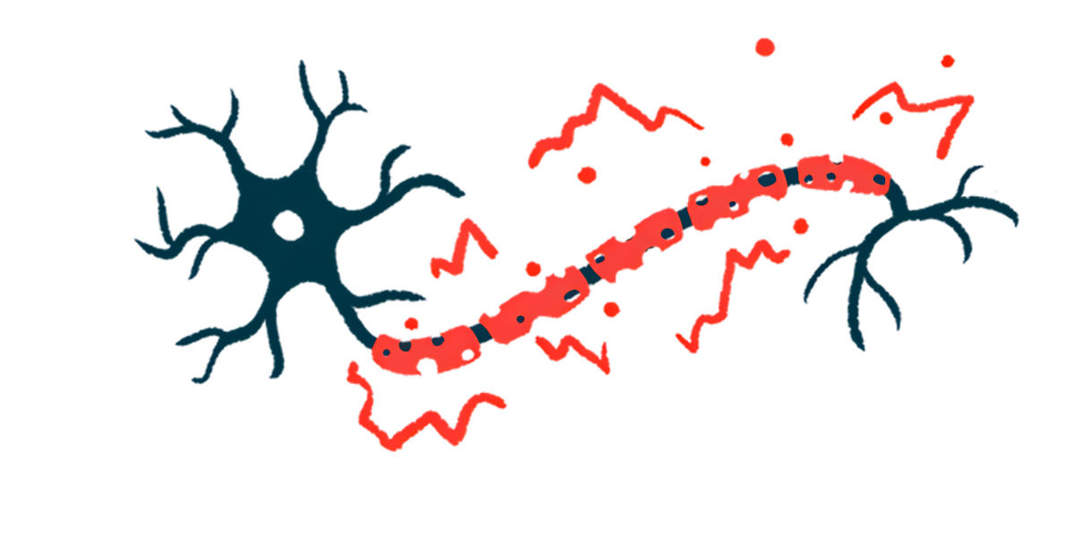 A close-up illustration of damaged myelin.