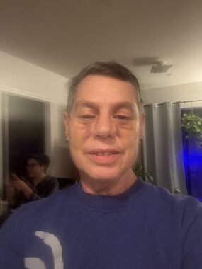 A woman takes a blurry selfie in someone's home. Injuries to her face are clearly healing, although some bruising is still visible around the eyes and nose. 