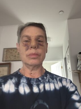 A woman takes a blurry selfie in her home, and there is massive bruising all over her face, particularly around her eyes and nose, and her nose is swollen.