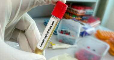 A photograph of a scientist holding a tube containing cerebrospinal fluid.
