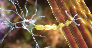 A representation of a nerve cell with degrading myelin.