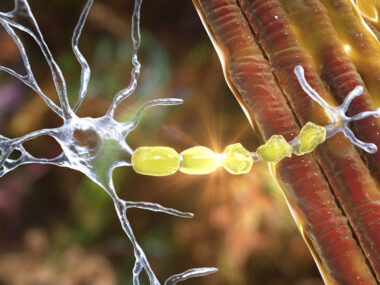 A representation of a nerve cell with degrading myelin.