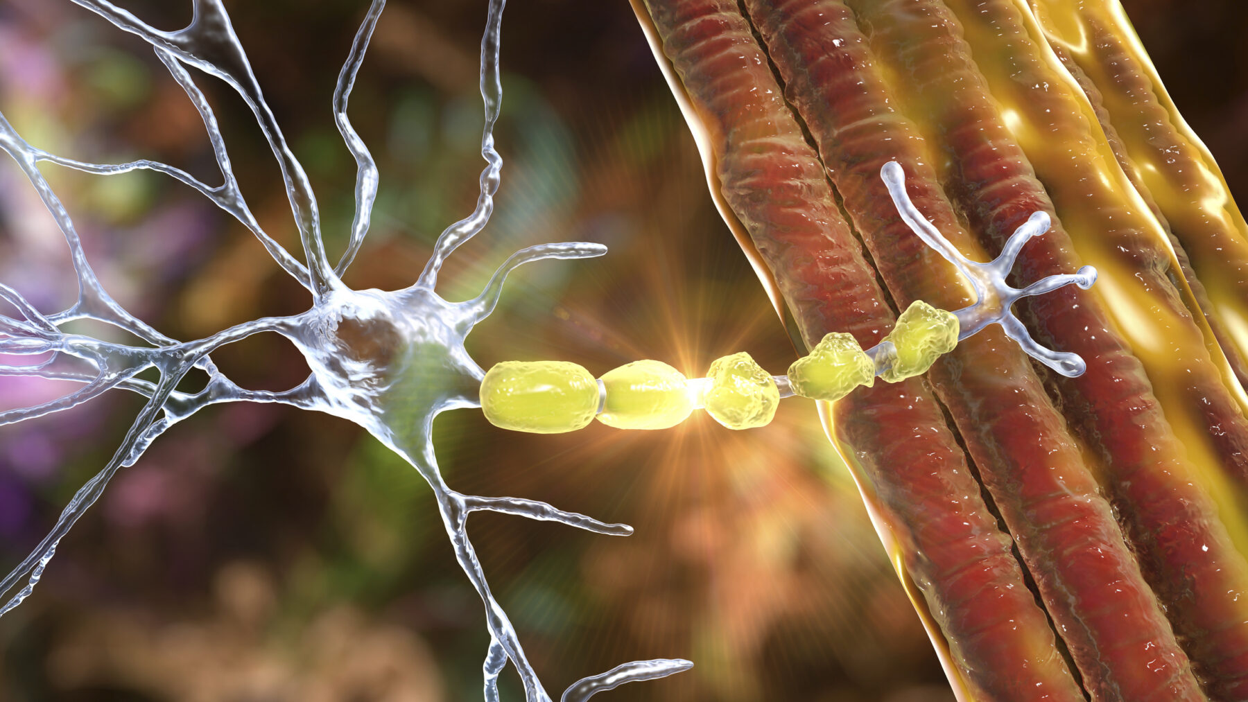 A representation of a nerve cell with degrading myelin.
