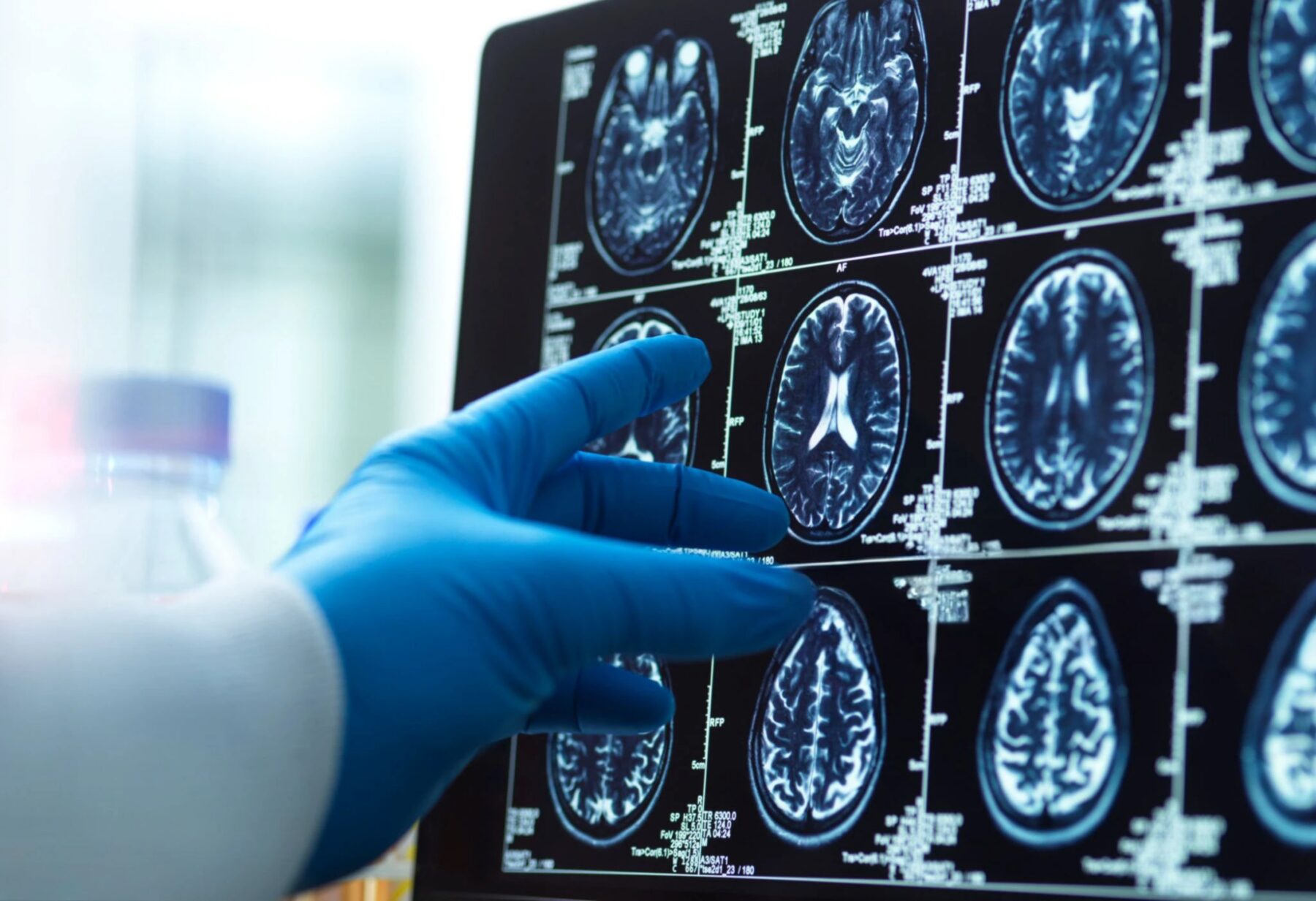 A doctor's gloved hand points to one of many images on a brain scan.