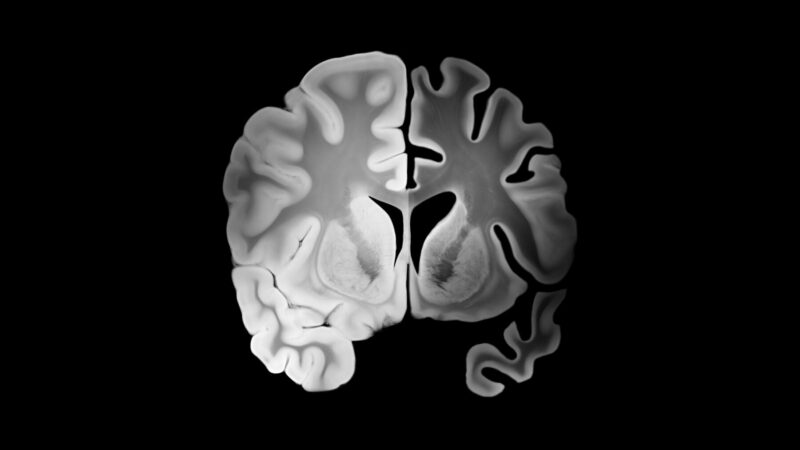 An image of a brain is shown.