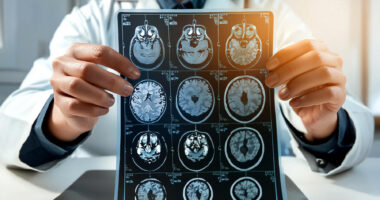 A doctor holds up an MRI brain scan of the head and skull.