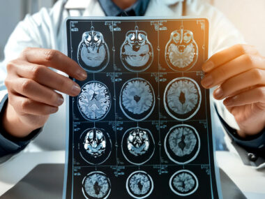 A doctor holds up an MRI brain scan of the head and skull.