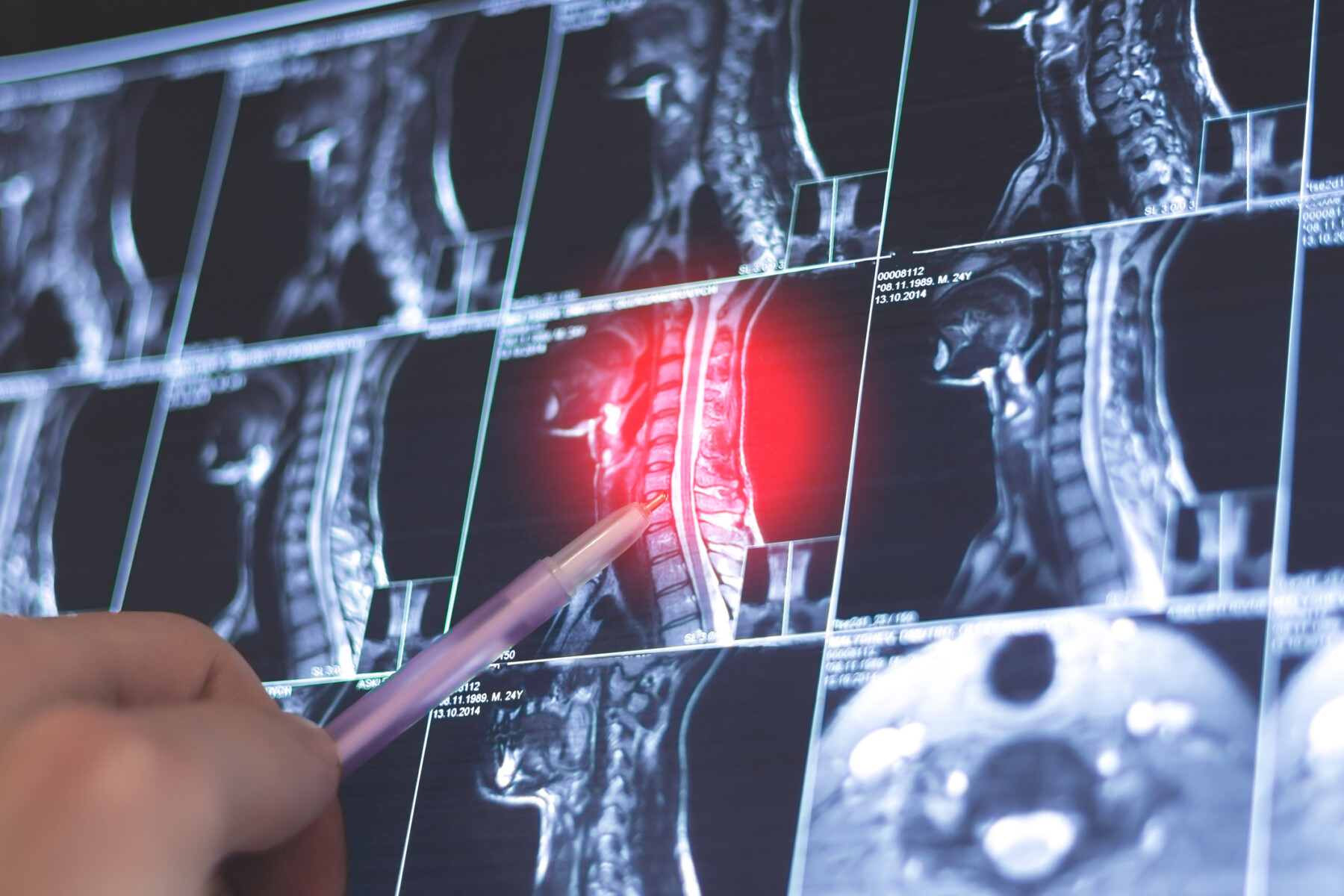 A human hand uses a small pointer to indicate an area highlighted in red on a series of imaging scans.
