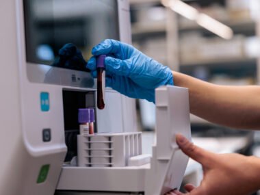 A photograph of a blood sample being processed in a lab for testing.