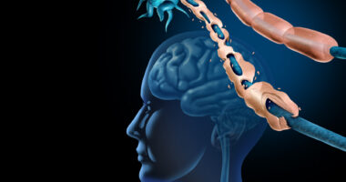 An image showing demyelination and nerve damage in the brain and central nervous system.