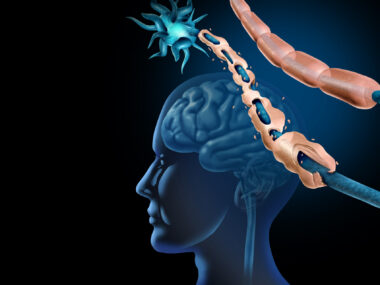 An image showing demyelination and nerve damage in the brain and central nervous system.