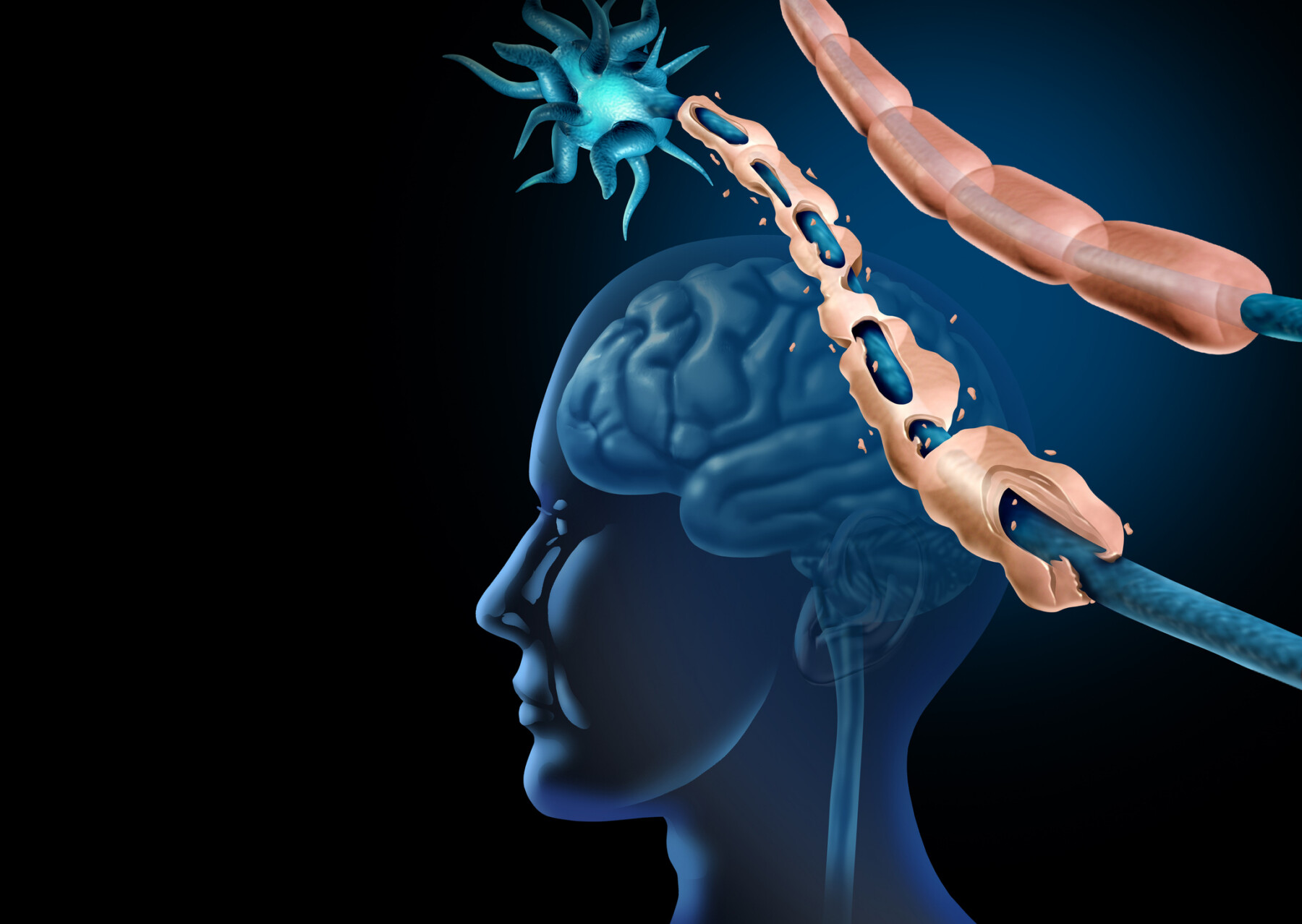 An image showing demyelination and nerve damage in the brain and central nervous system.