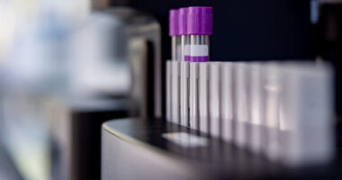 A close-up look at a blood analyzing machine at a laboratory.