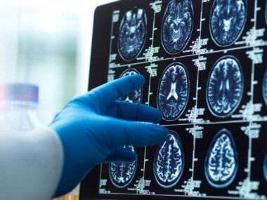 A photo shows a gloved hand touching brain images from a scan.