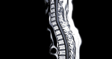 An MRI scan of the spinal cord.