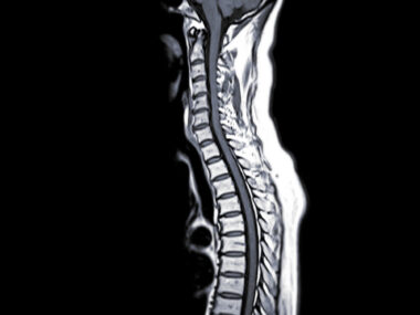An MRI scan of the spinal cord.
