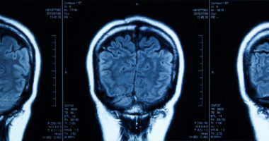 Three MRI images show different amounts of white matter in a human brain.
