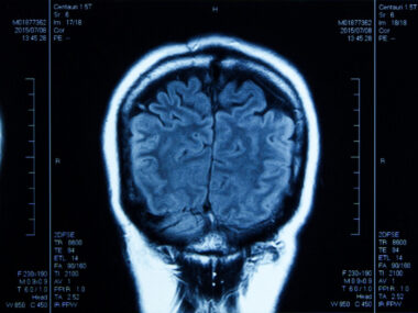 An image shows an MRI scan of a human head.