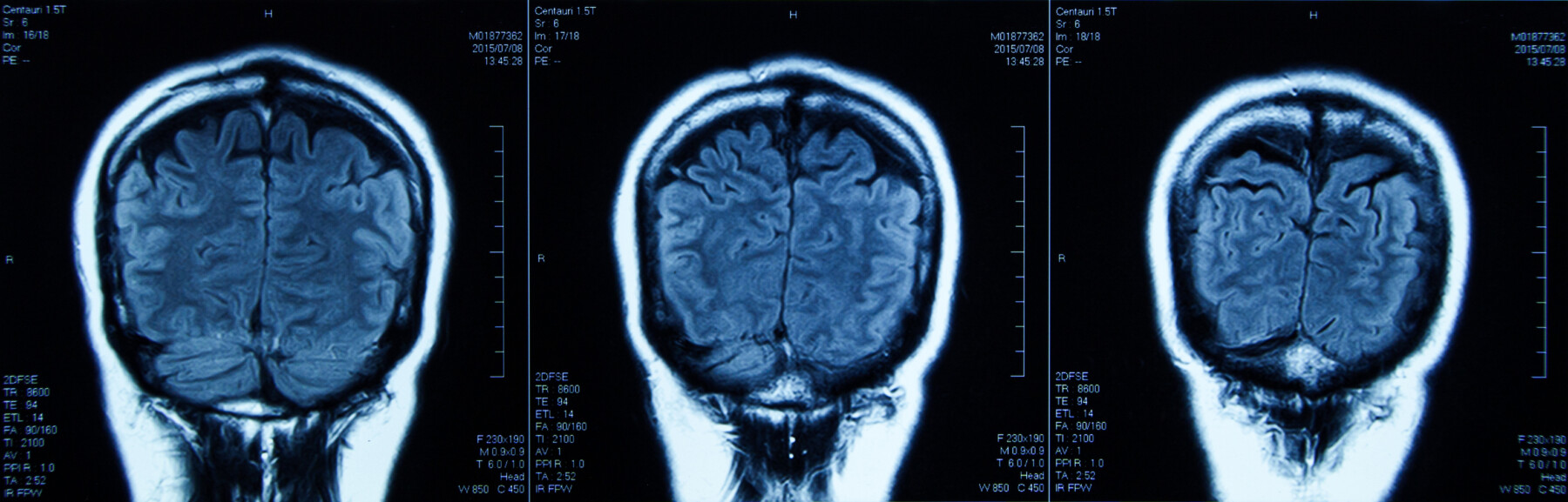 An image shows an MRI scan of a human head.