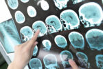 A healthcare professional points to a series of brain MRI scans displayed on a medical imaging screen.