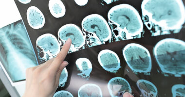 A healthcare professional points to a series of brain MRI scans displayed on a medical imaging screen.