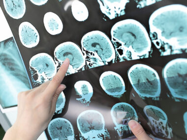 A healthcare professional points to a series of brain MRI scans displayed on a medical imaging screen.