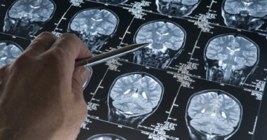 A photo shows a hand pointing at something on a brain scan.