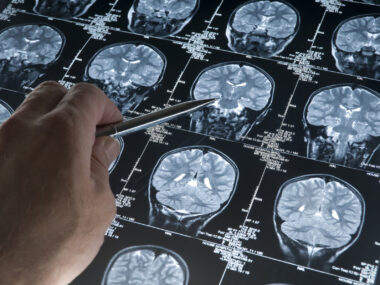 A photo shows a hand pointing at something on a brain scan.