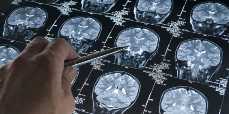 A photo shows a hand pointing at something on a brain scan.