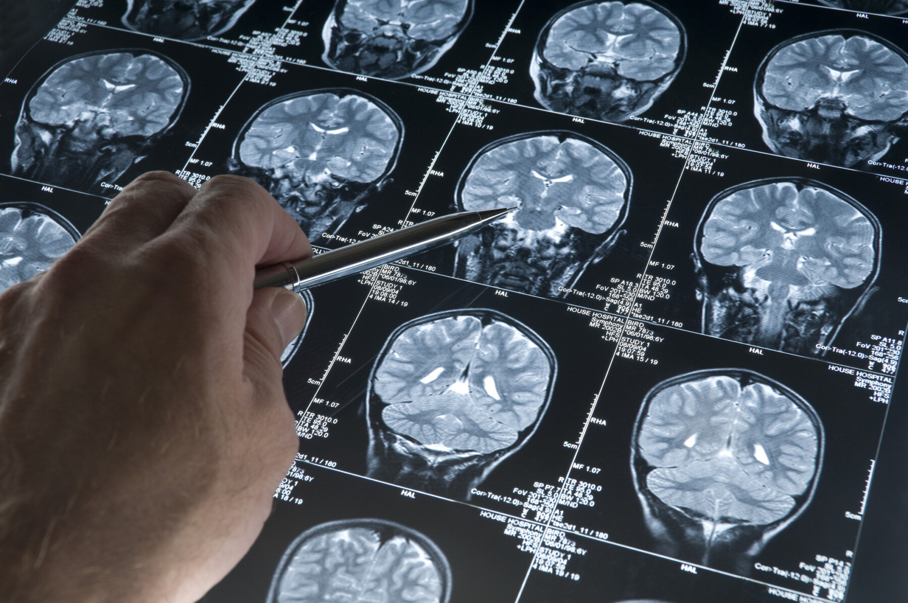 A photo shows a hand pointing at something on a brain scan.