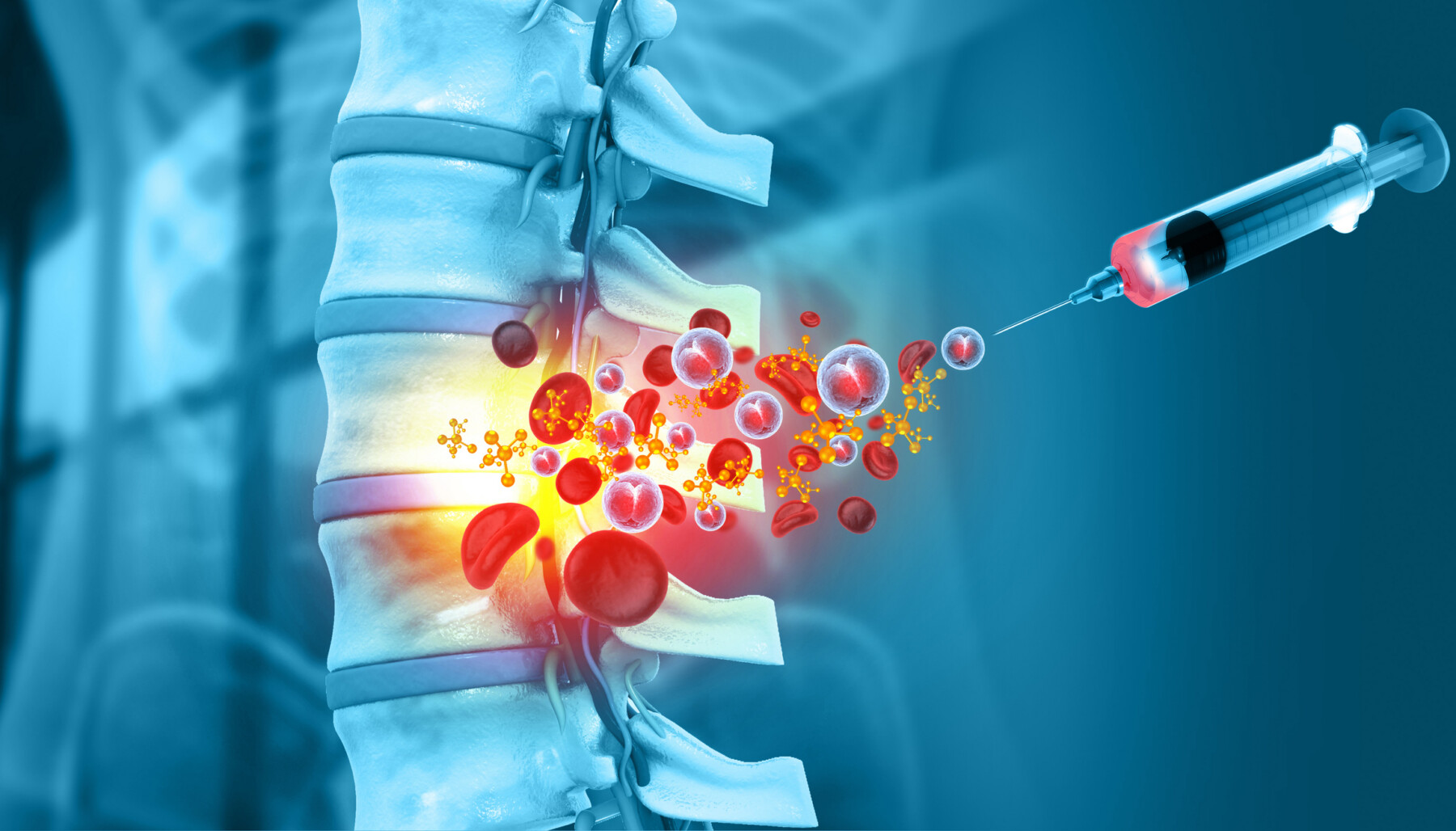 An image shows medicine being injected into a human spine.